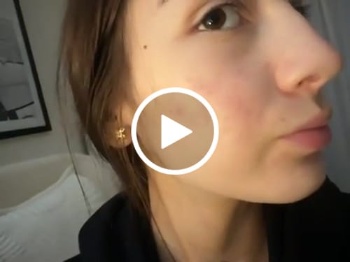 Customer video review of Starter Acne Program™