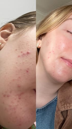 Customer's before-and-after image showing a significant reduction in cheek acne after using the Starter Acne Program™.