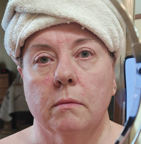 Reviewer's face showing red, dry skin before using F-Balm.