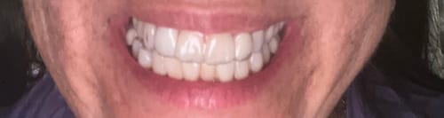 Close-up of a customer smiling, wearing clear retainers on their upper and lower teeth.