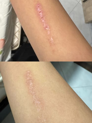 Customer photo review of Eczema Scratch Mitten