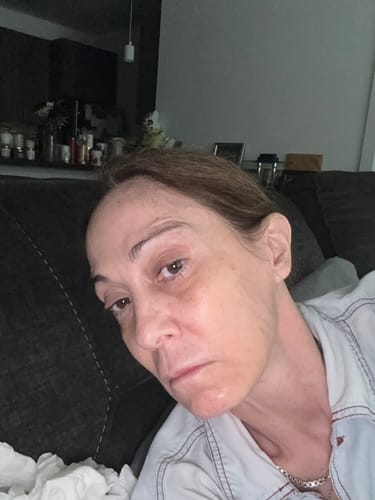 Reviewer's selfie showing their facial skin after using the Seranova Micro Infusion System.