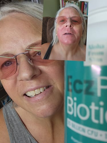 Customer photo review of EczPro - Probiotics for Eczema, Natural Remedy, 13 Histamine-Safe Strains, Allergen-Free Formula
