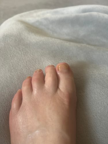Close-up of a customer's foot with discolored toenails being treated with Fungal Freedom oil.