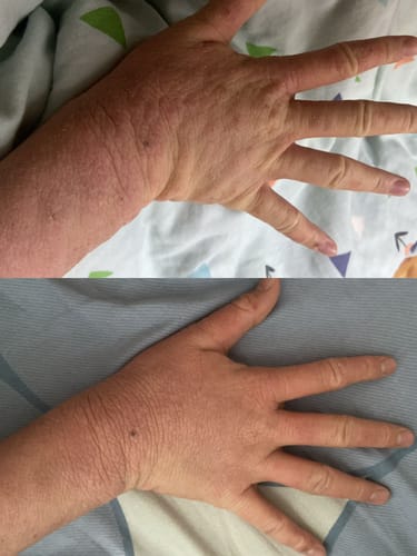 Customer photo review of Eczema Scratch Mitten