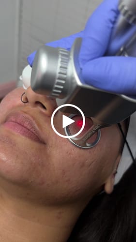 Customer video review of SmartPulse™ COOL Professional CO2 Fractional Laser