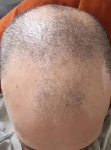 Customer photo review of Avernea Advanced Batana Hair Regrowth Therapy