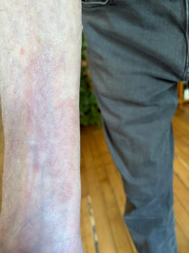 Close-up of a reviewer's arm, where a skin condition has mostly faded after applying F-Balm.