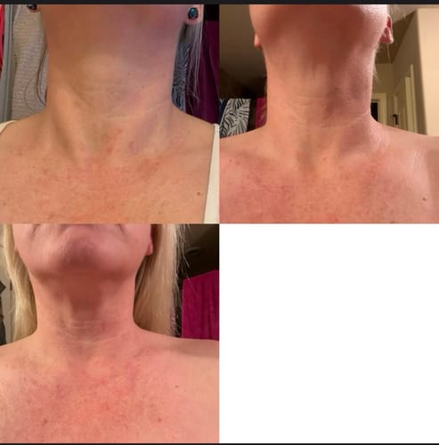 Customer's collage showing their neck skin during treatment with the Micro Infusion System.