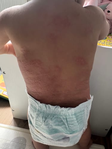 Reviewer's photo showing a baby's back with red, inflamed skin before using the Calm Balm.