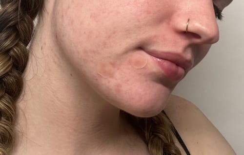 Close-up of a customer's face with two discreet Pimple Pals patches applied over pimples near their mouth.