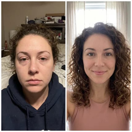 Comparación de una clienta antes y después de usar Lumi Balance Drink™, mostrando una notable reducción de la hinchazón facial.
