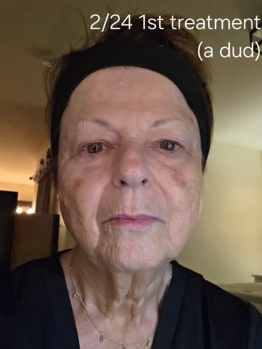 Reviewer's face before starting treatments with the Micro Infusion System, as noted in their first photo.