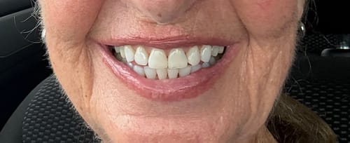 Close-up of a reviewer's bright smile, showing straight teeth after using the Retainer-Night Guard set.