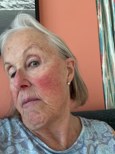 Reviewer's close-up photo showing her facial skin after using The Micro Infusion System.
