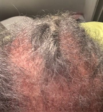 Close-up of a customer's scalp with thinning gray hair, showing a balding area being treated with Rennora Hair Growth Serum.