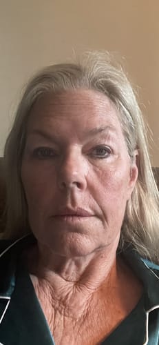 Reviewer's face in a recent photo after treatment with The Micro Infusion System, showing smoother skin.