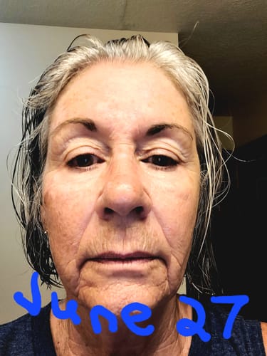 Reviewer's face after a fourth treatment with the Seranova Micro Infusion System.