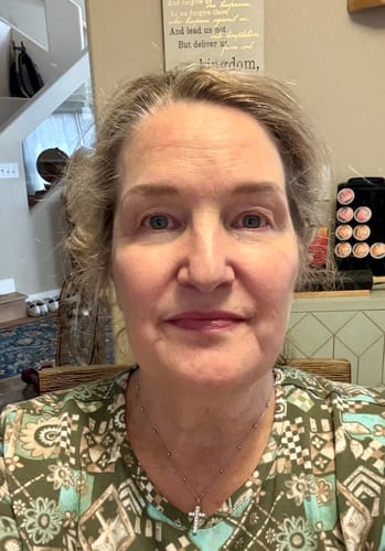 Reviewer's facial close-up after 3 months of using the Seranova Micro Infusion System for fine lines.