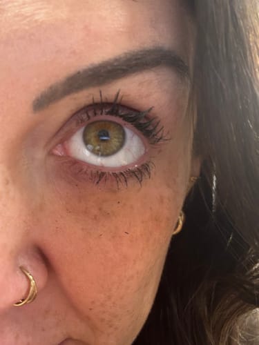 Customer's close-up of the eye area showing tighter skin after using the Seranova Micro Infusion System.