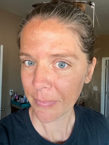 A reviewer's face showing the fine lines and melasma they are treating with the Micro Infusion System.