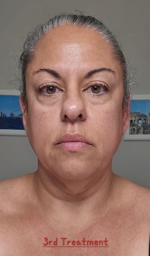 Reviewer's face after the third treatment with the Seranova Micro Infusion System, showing visible improvement.