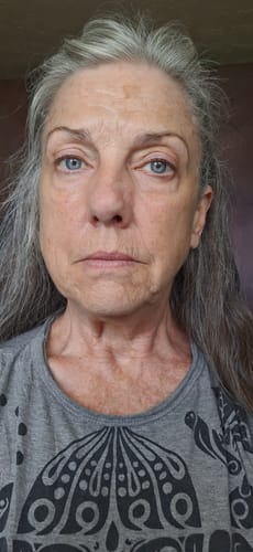 A frontal view of the reviewer's face, showing skin after using the Seranova Micro Infusion System for two months.