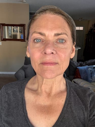 Reviewer's selfie showing their facial skin after four treatments with the Seranova Micro Infusion System.