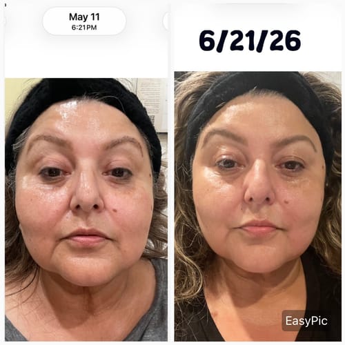 Customer's before-and-after photos showing improved facial skin after using the Seranova Micro Infusion System.