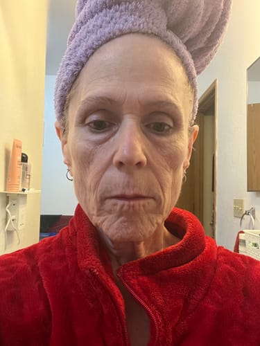 Reviewer showing her facial skin and wrinkles before reusing the Seranova Micro Infusion System.
