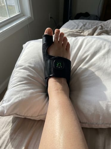 Customer photo review of Nexalign Pro — EMS Bunion Corrector