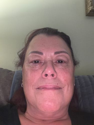 A customer's selfie showing their facial skin after using the Seranova Microneedling Infusion System.