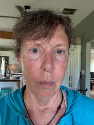 Reviewer's 'before' selfie showing facial puffiness prior to using the Seranova Micro Infusion System.