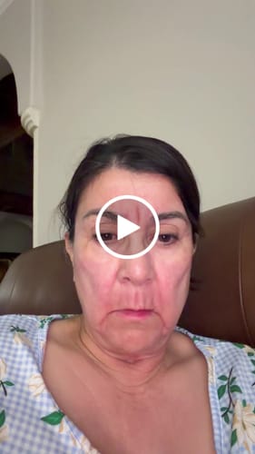 Customer video review of 3 Month Supply - Seranova Micro Infusion System
