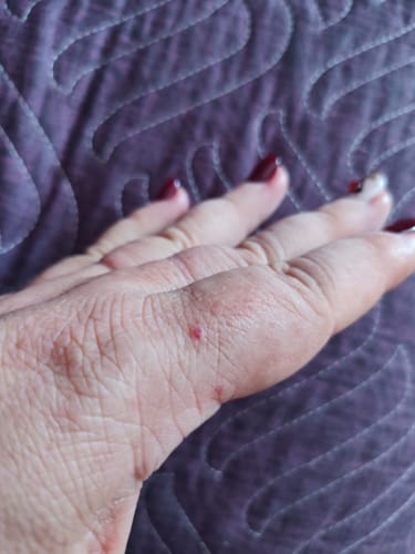 Customer's hand with healing skin, showing the results of using Sereni Psoriasis and Eczema Cream.