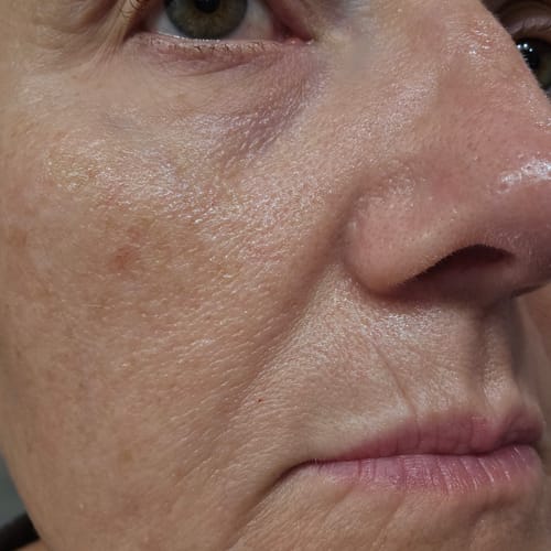 Close-up of reviewer's facial skin, documenting progress with the Seranova Micro Infusion System.
