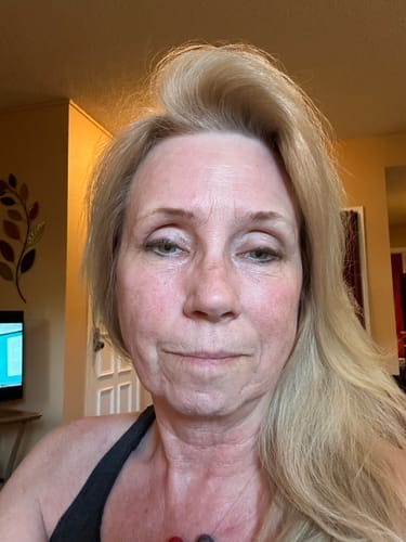 Reviewer shares a close-up of their face, showing skin with fine lines after using the Seranova Micro Infusion System.