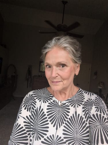 Customer's face showing skin results after using The Micro Infusion System for one month.