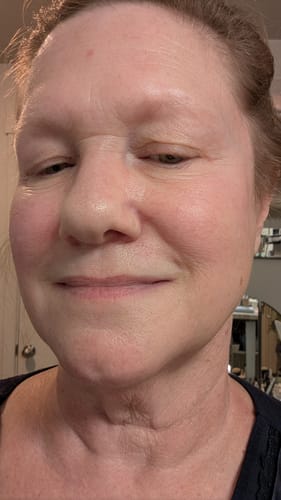 Customer's face after about a month using the Seranova Micro Infusion System.
