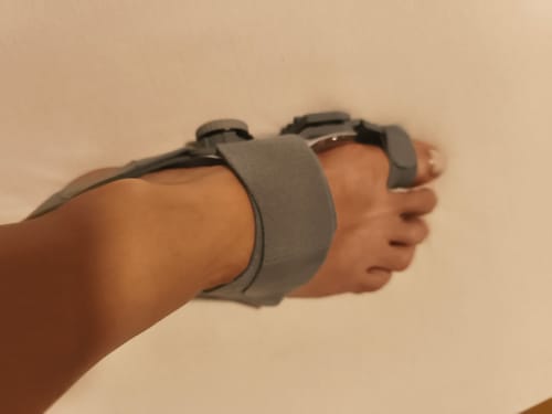 Reviewer wearing the Ortolin Night Bunion Protector and Toe Corrector splint on their foot.
