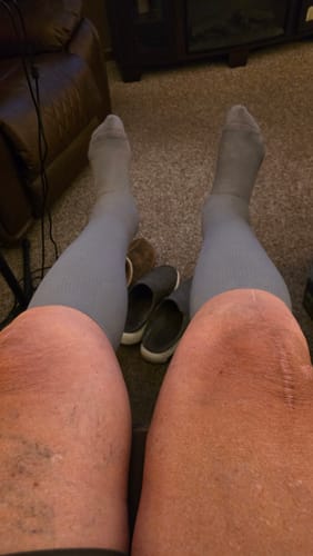 Customer's Eucalyptus Lyocell Compression Socks worn on legs to help with ankle edema, in a living room setting.