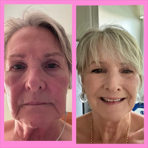 Reviewer's comparison showing face before and after six months of using The Micro Infusion System.