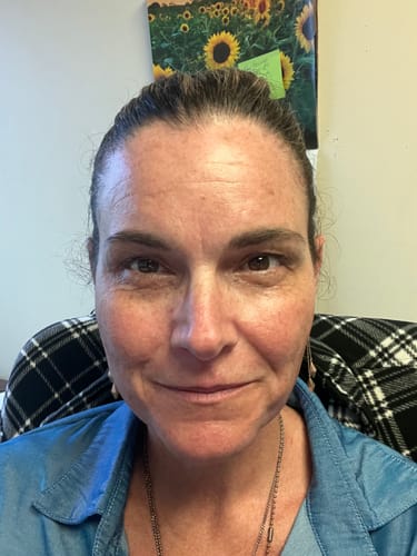 Customer's face showing results after using the Seranova Micro Infusion System.