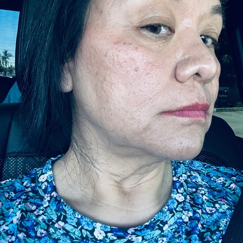Close-up of a reviewer's face showing skin texture after using The Micro Infusion System in a car.