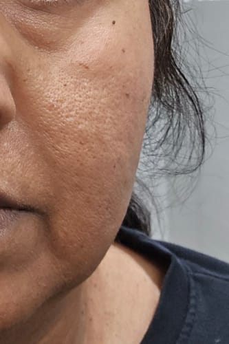 Close-up of a reviewer's cheek before using The Micro Infusion System, showing visible pores and skin texture.