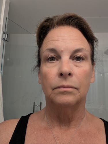 Customer selfie showing their facial skin and lines after using the Seranova Microneedling Infusion System.