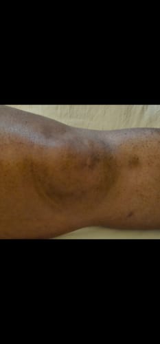 Customer's skin showing faded scar area after using the Turmeric Brightening Soap.