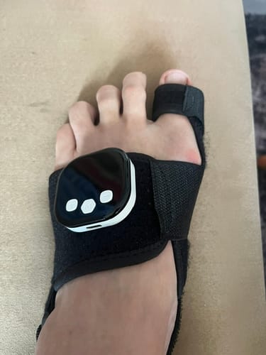 Customer's Nexalign Pro EMS Bunion Corrector worn on the foot, featuring a black strap and electronic control unit.