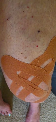 Customer photo review of APRIS™ Knee Support — Pre-Cut Kinesiology Tape