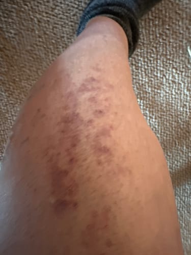 Customer photo review of APRIS Knee Support // Pre-Cut Kinesiology Tape